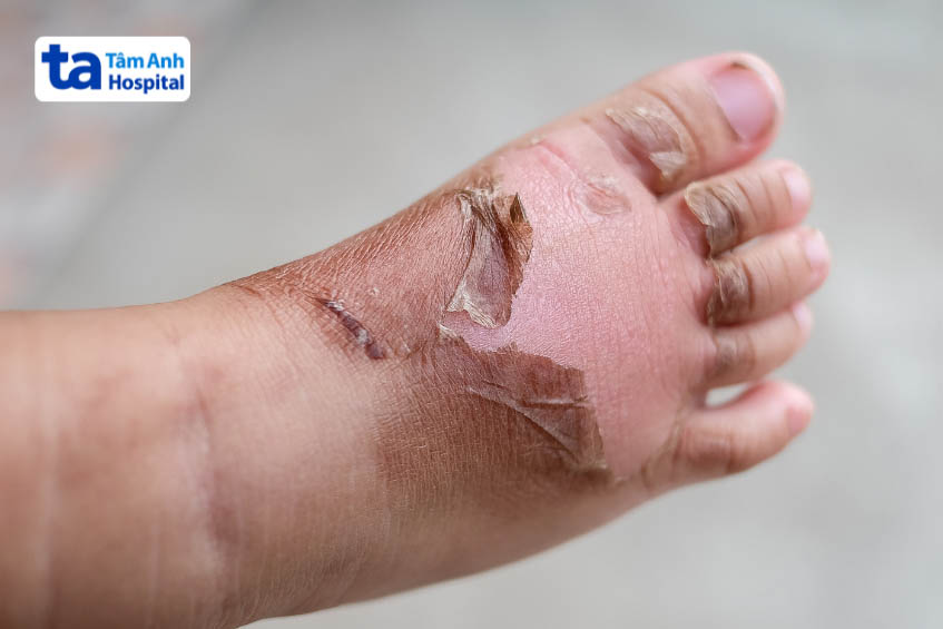 Cách Điều Trị Bỏng Bô Xe Máy Đúng Cách Giảm Nguy Cơ Sẹo 4 Cách Điều Trị Bỏng Bô Xe Máy Đúng Cách Giảm Nguy Cơ Sẹo