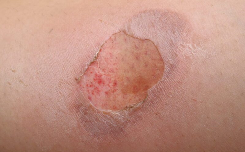 Cách Điều Trị Bỏng Bô Xe Máy Đúng Cách Giảm Nguy Cơ Sẹo