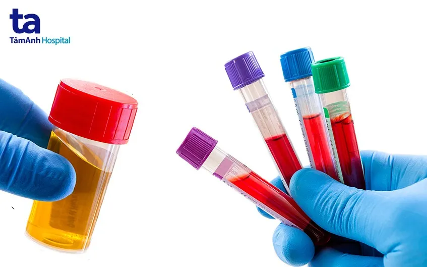 Hình ảnh mô tả khối u bướu thận, một trong những nguyên nhân nghiêm trọng gây đi tiểu ra máu