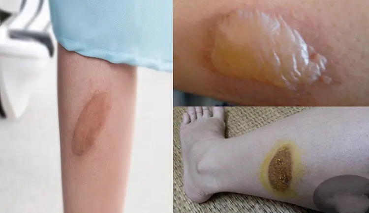 Cách Chữa Bỏng Bô Xe Máy Nhanh Khỏi, Không Để Lại Sẹo: Hướng Dẫn Chi Tiết Từ Chuyên Gia